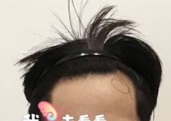 -大麦微针植发全国连锁