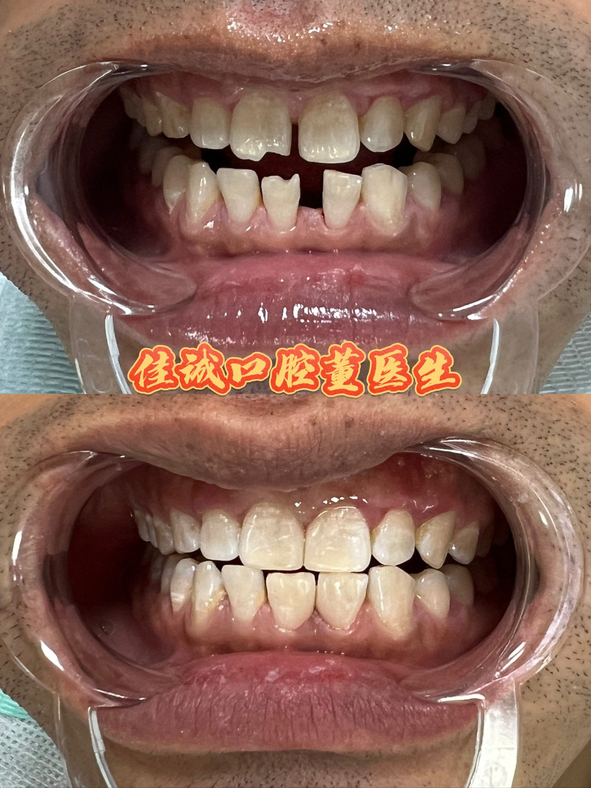 为什么牙齿缝隙越来越大