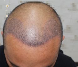 -大麦微针植发丨全国连锁