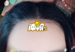 -大麦微针植发全国连锁