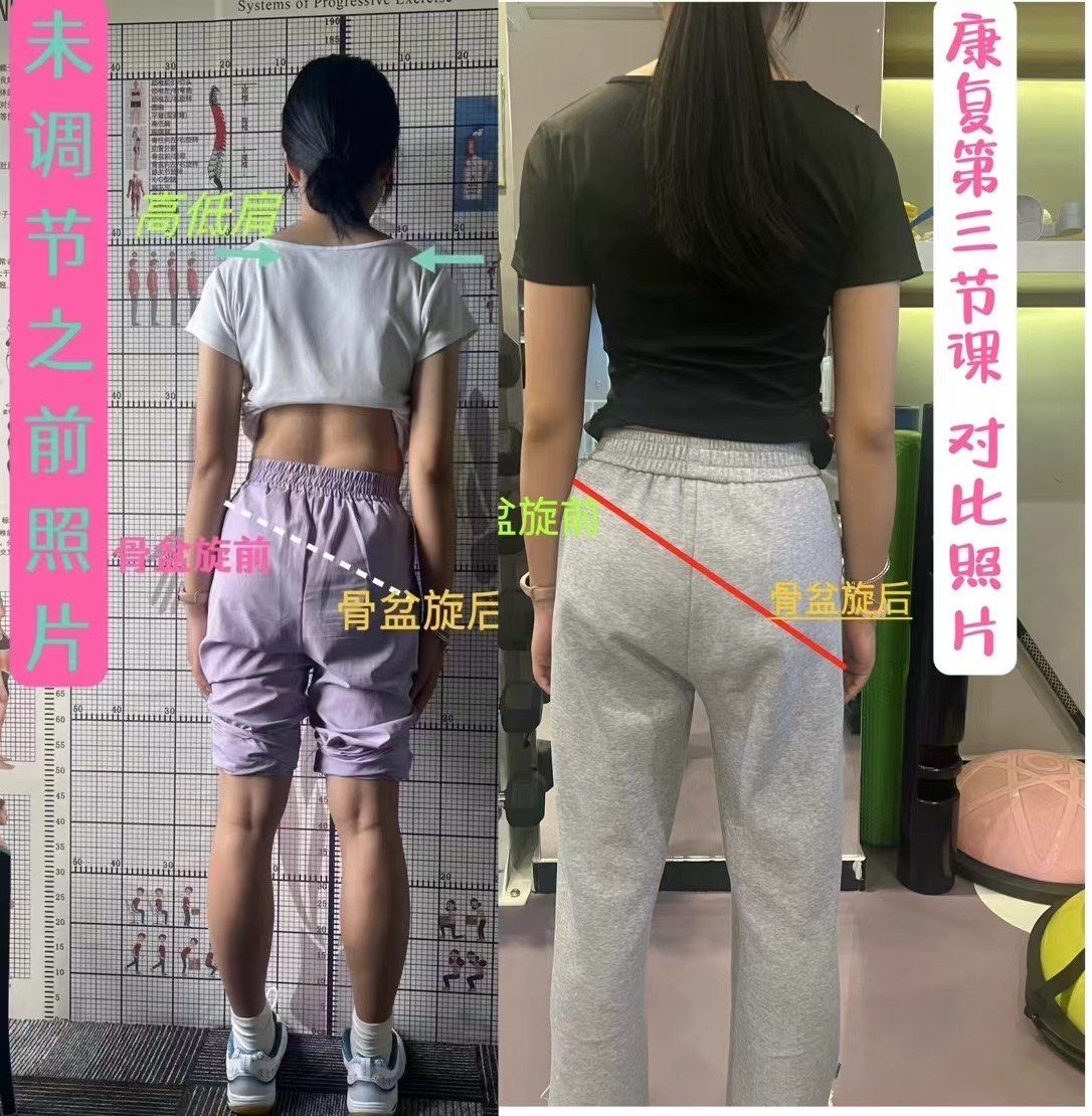 女性骨盆一高一低 ,骨盆前倾康复纠正