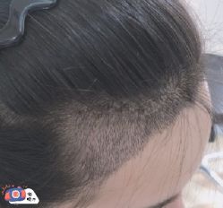 -大麦微针植发丨全国连锁