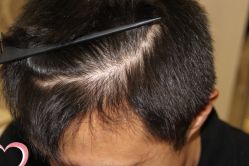 -大麦微针植发丨全国连锁