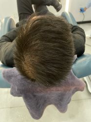 体验后-大麦微针植发全国连锁