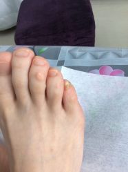 -德哥灰指甲脚气甲沟炎跖疣护理