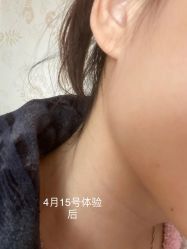 体验后-杭州米兰柏羽医疗美容医院