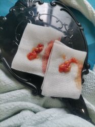 点击看大图 体验后-天津健丽·去眼袋医疗美容机构
