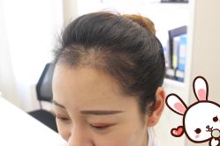 点击看大图 -大麦微针植发丨全国连锁