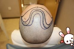 -大麦微针植发丨全国连锁