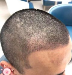 -大麦微针植发丨全国连锁