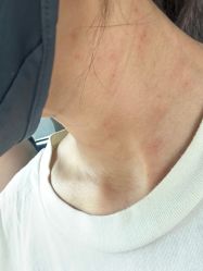 -美丽人生祛斑扁平疣汗管瘤中心
