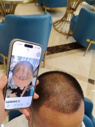 -碧莲盛·不剃发植发