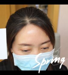 点击看大图 -大麦微针植发全国连锁