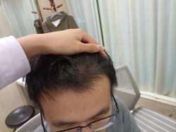 点击看大图 -碧莲盛·不剃发植发