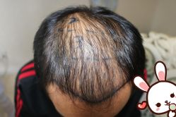 点击看大图 -大麦微针植发丨全国连锁