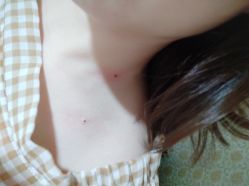 -痣清宫祛斑祛痣连锁店