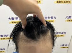 -大麦微针植发全国连锁