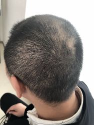 点击看大图 -大麦微针植发丨全国连锁