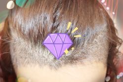 -大麦微针植发全国连锁