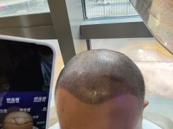 -碧莲盛·不剃发植发