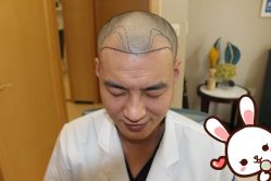 -大麦微针植发丨全国连锁