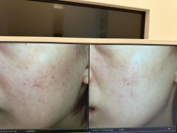 -苑苑vbeauty科技美容SPA