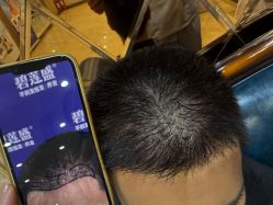 -碧莲盛·不剃发植发