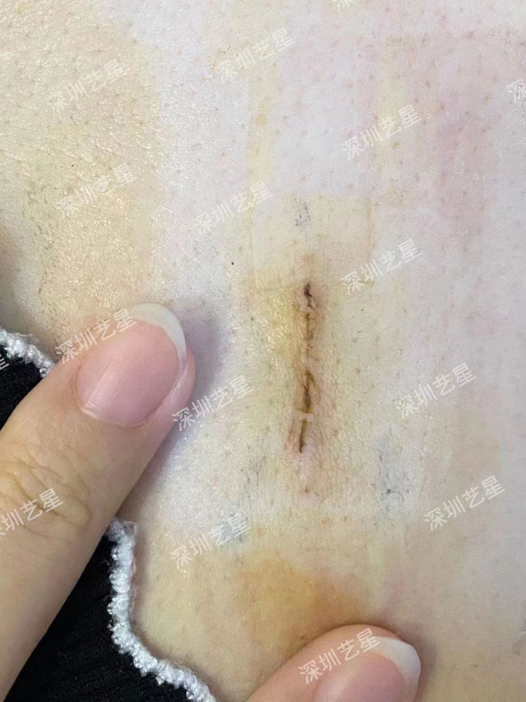 隆胸的疤痕到底是怎么样的?