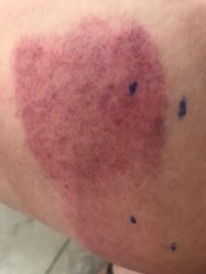 -肥三针腧穴瘦身馆