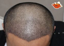 -大麦微针植发丨全国连锁