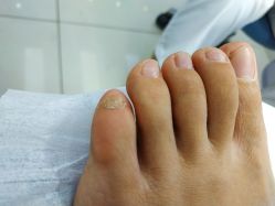 -派恩宜灰指甲鸡眼嵌甲手足癣