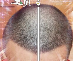 -大麦微针植发全国连锁
