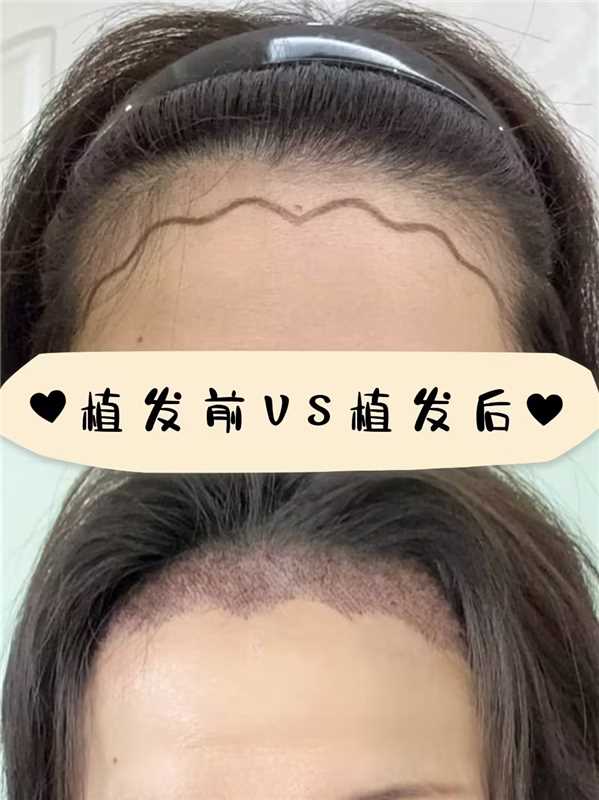 脸颊可以植发吗(脸颊的头发能不能剔除)