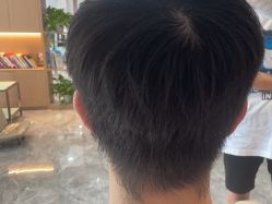 -碧莲盛·不剃发植发