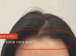 -大麦微针植发全国连锁