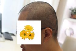 -大麦微针植发丨全国连锁
