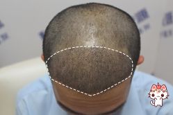 -大麦微针植发丨全国连锁