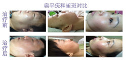 -美丽人生祛斑扁平疣汗管瘤中心