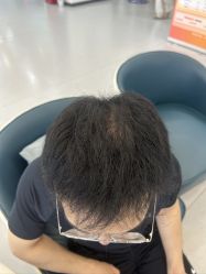 -大麦微针植发全国连锁