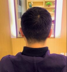 -大麦微针植发丨全国连锁