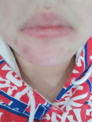 -痘瑞仕·专业祛痘国际连锁