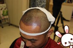 点击看大图 -大麦微针植发丨全国连锁