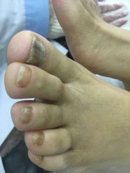 点击看大图 -德哥灰指甲脚气甲沟炎跖疣护理