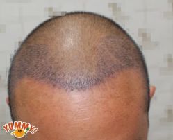 -大麦微针植发丨全国连锁