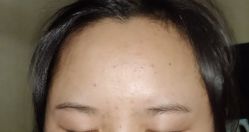 -蕾特恩专业祛痘国际连锁