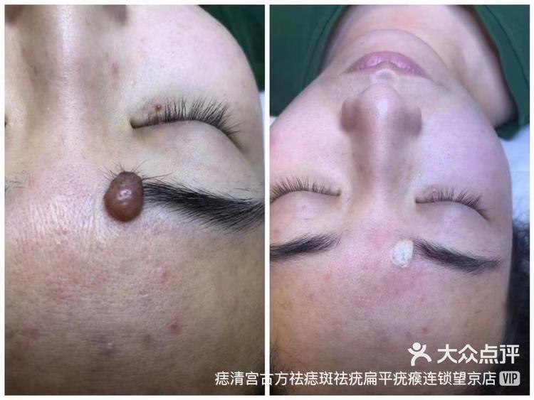 眉毛的大肉痣终于去除了