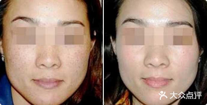 激光点痣E光祛斑 皮秒激光 激光去纹身