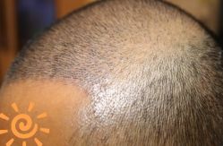 -大麦微针植发丨全国连锁