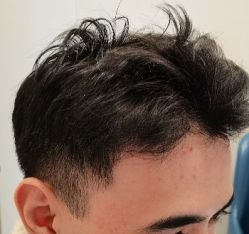 -大麦微针植发全国连锁