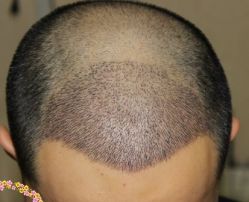 -大麦微针植发丨全国连锁